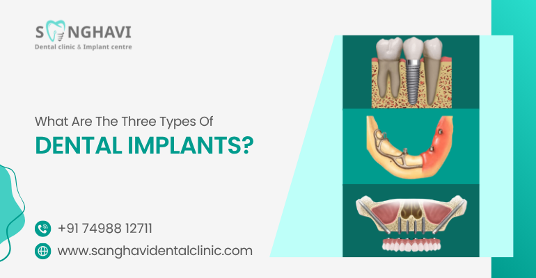What Are The Three Types Of Dental Implants?