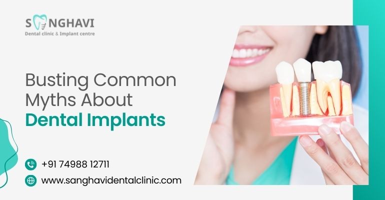 Busting Common Myths About Dental Implants