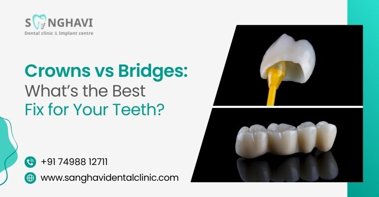 Crowns vs. Bridges: What’s the Best Fix for Your Teeth?