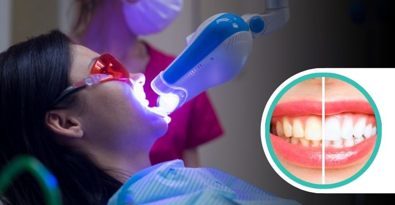 Teeth Whitening In Baramati  